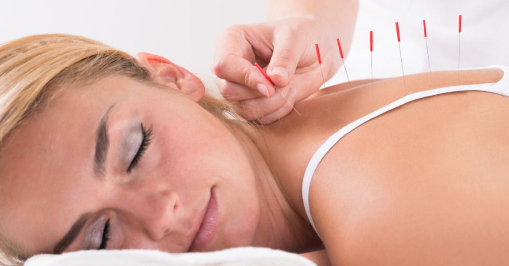 Das Bild zeigt eine entspannte Frau mit Akupunkturnadeln im Rücken als Sinnbild für die Möglichkeiten zur Linderung durch alternative Heilmethoden oder die Komplementärmedizin